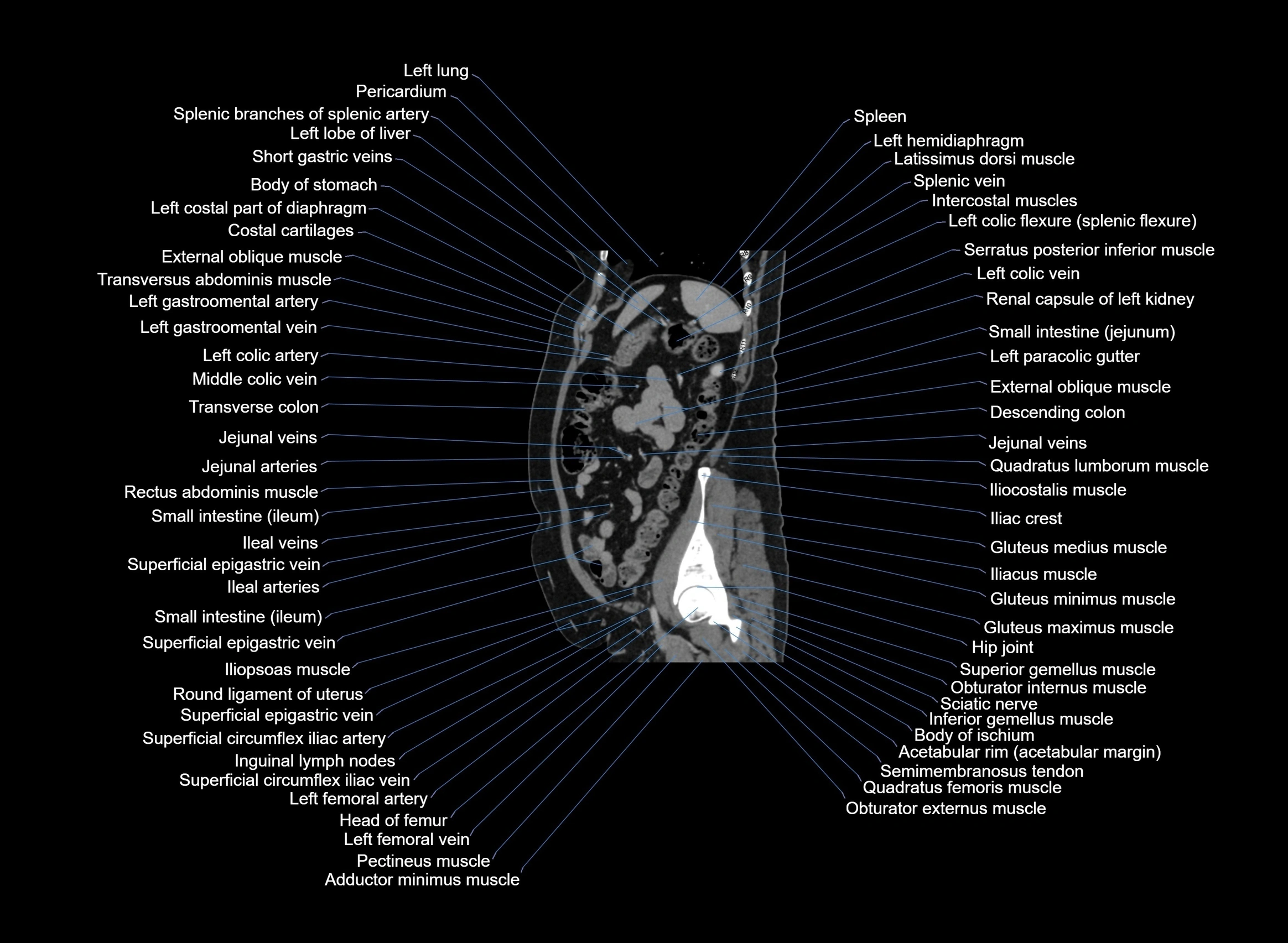 CT Abdomen sagittal cross sectional anatomy labelled radiology image -00031.webp